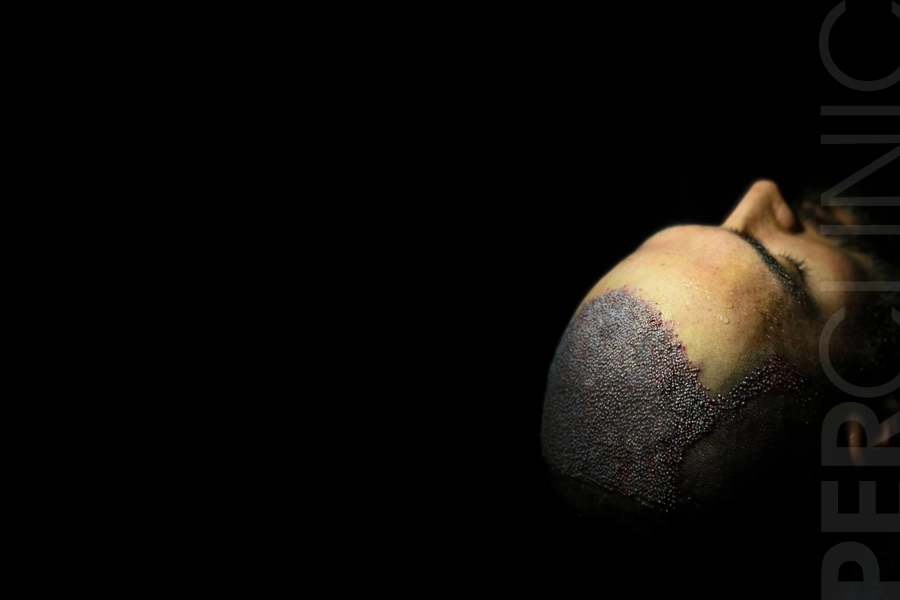 FUE Hair Transplant Turkey | Per Clinic